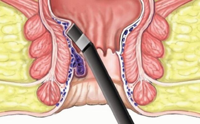 coagulación de hemorroides en hemorroides